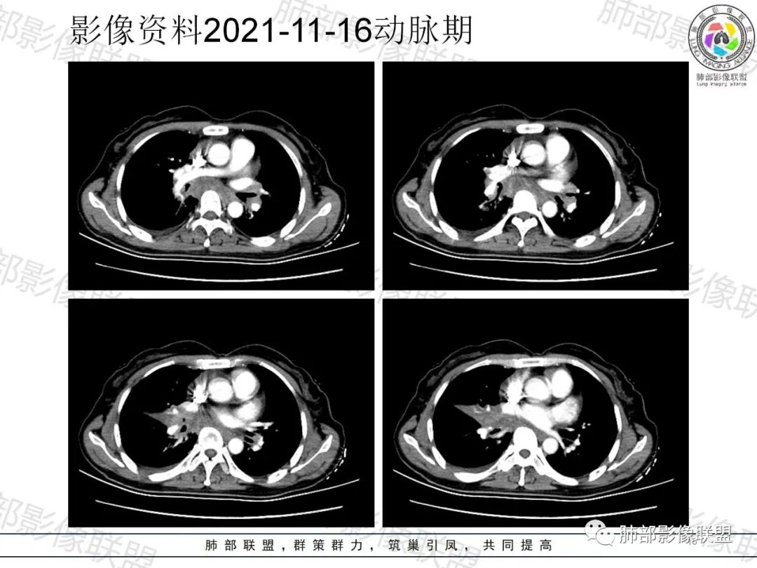 影像PPT - 【病例】诡异多变的结核-16 影像PPT - 【病例】诡异多变的结核-16