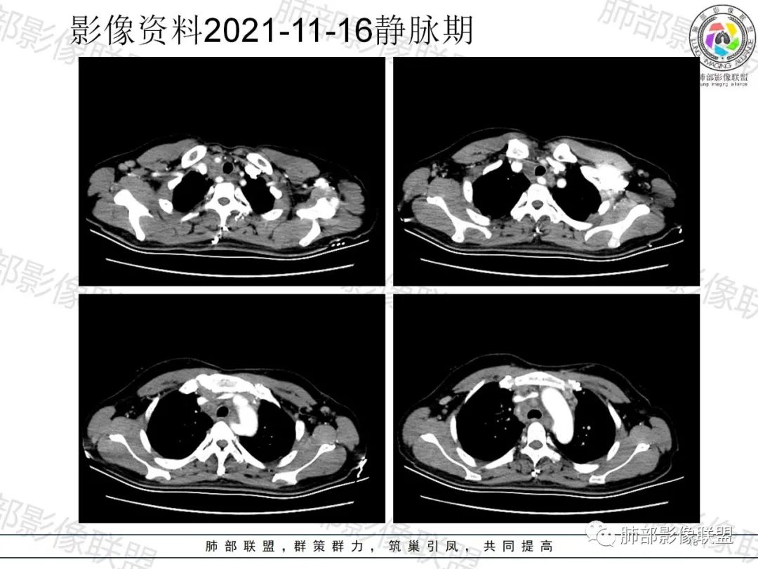 影像PPT - 【病例】诡异多变的结核-17 影像PPT - 【病例】诡异多变的结核-17