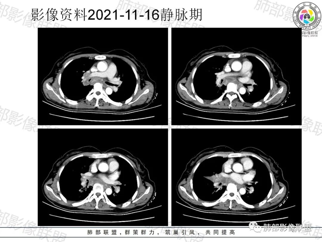 影像PPT - 【病例】诡异多变的结核-19 影像PPT - 【病例】诡异多变的结核-19