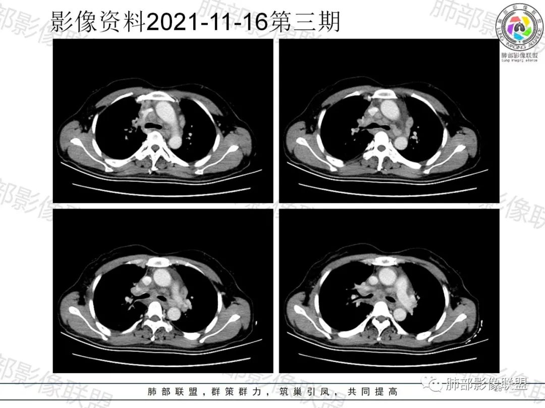 影像PPT - 【病例】诡异多变的结核-22 影像PPT - 【病例】诡异多变的结核-22