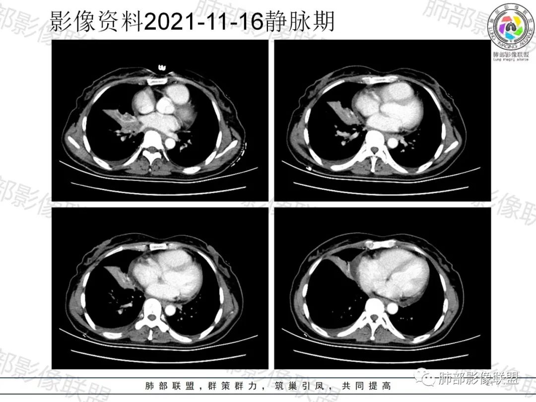 影像PPT - 【病例】诡异多变的结核-20 影像PPT - 【病例】诡异多变的结核-20