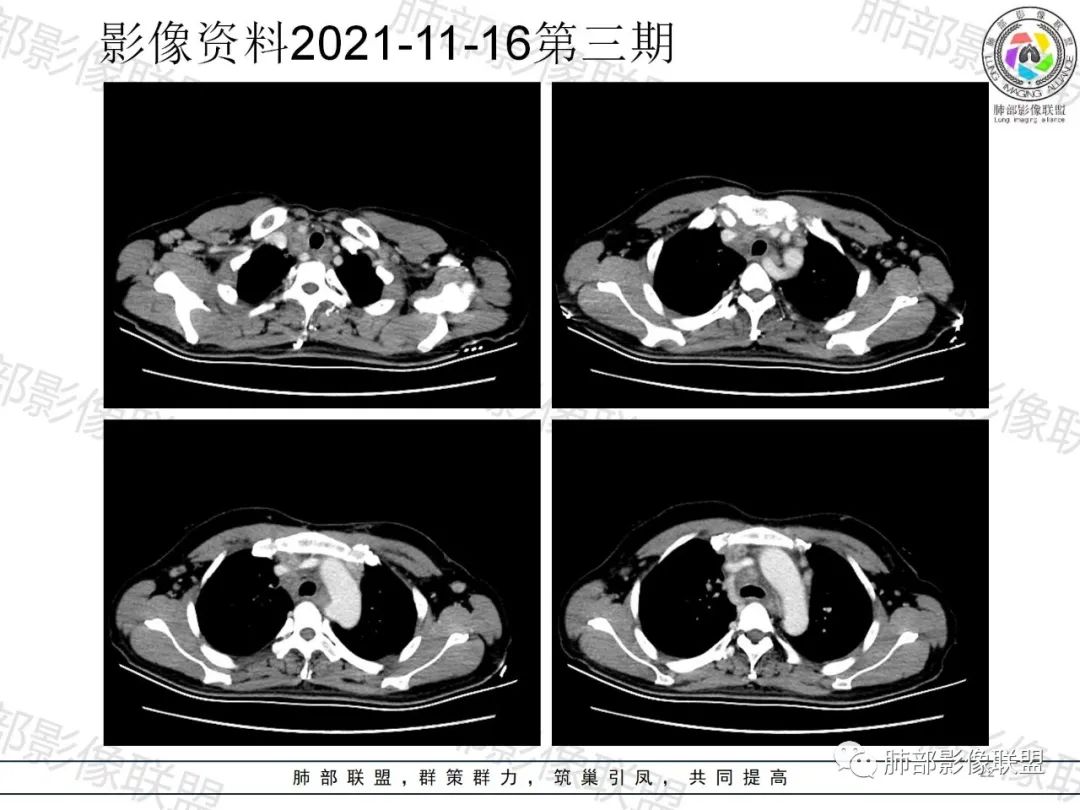 影像PPT - 【病例】诡异多变的结核-21 影像PPT - 【病例】诡异多变的结核-21