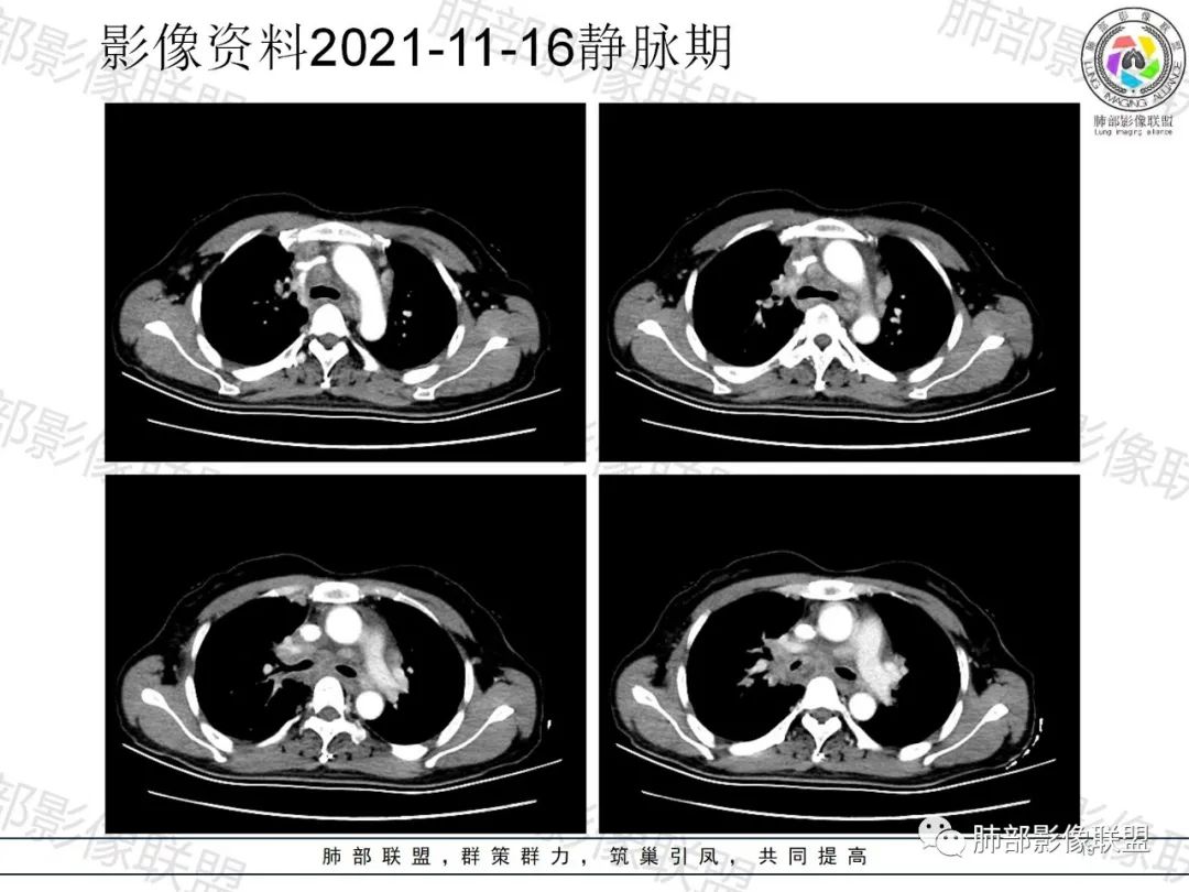 影像PPT - 【病例】诡异多变的结核-18 影像PPT - 【病例】诡异多变的结核-18