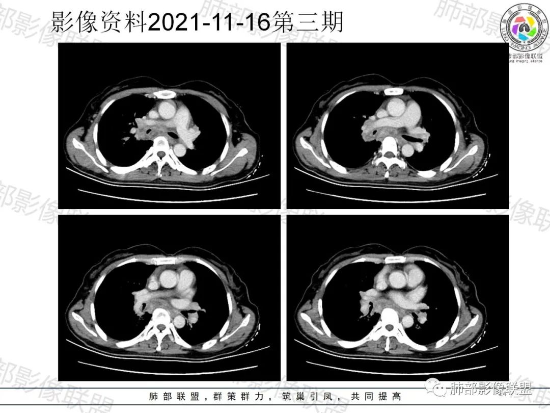 影像PPT - 【病例】诡异多变的结核-23 影像PPT - 【病例】诡异多变的结核-23