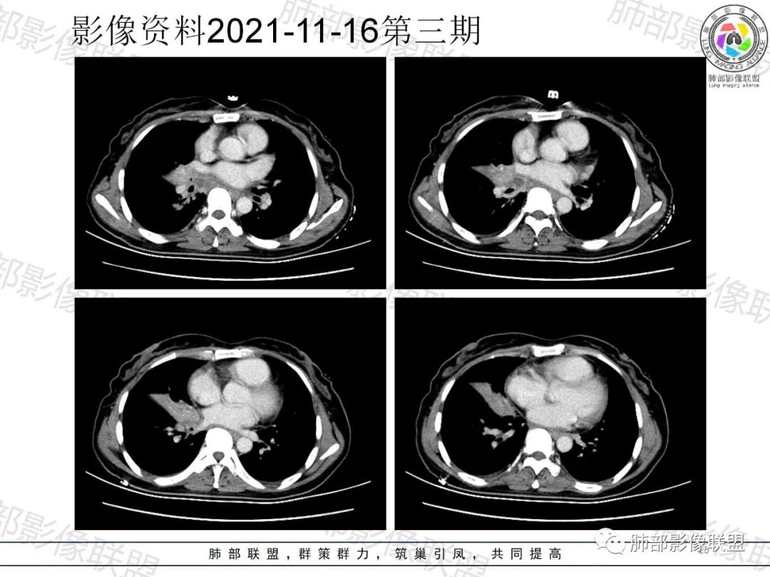 影像PPT - 【病例】诡异多变的结核-24 影像PPT - 【病例】诡异多变的结核-24