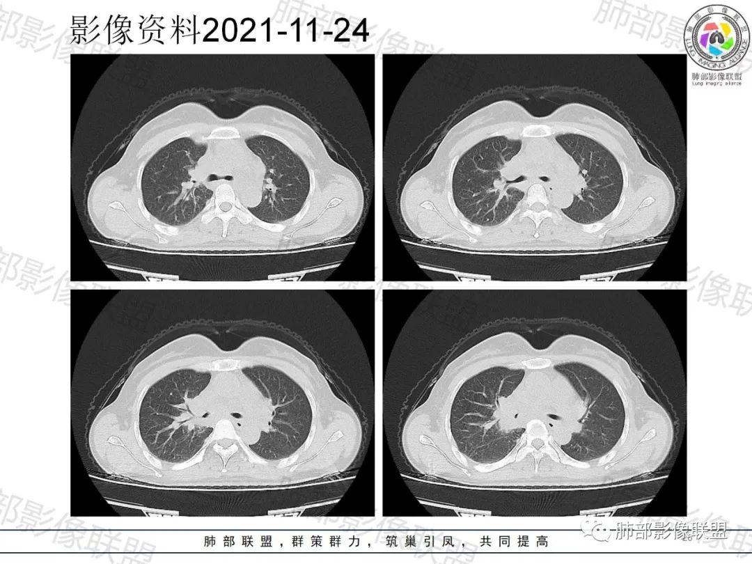 影像PPT - 【病例】诡异多变的结核-25 影像PPT - 【病例】诡异多变的结核-25