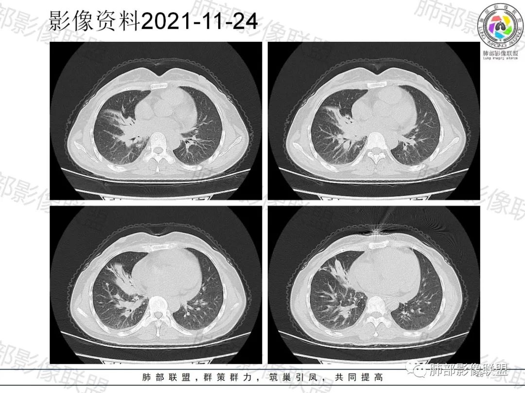 影像PPT - 【病例】诡异多变的结核-27 影像PPT - 【病例】诡异多变的结核-27