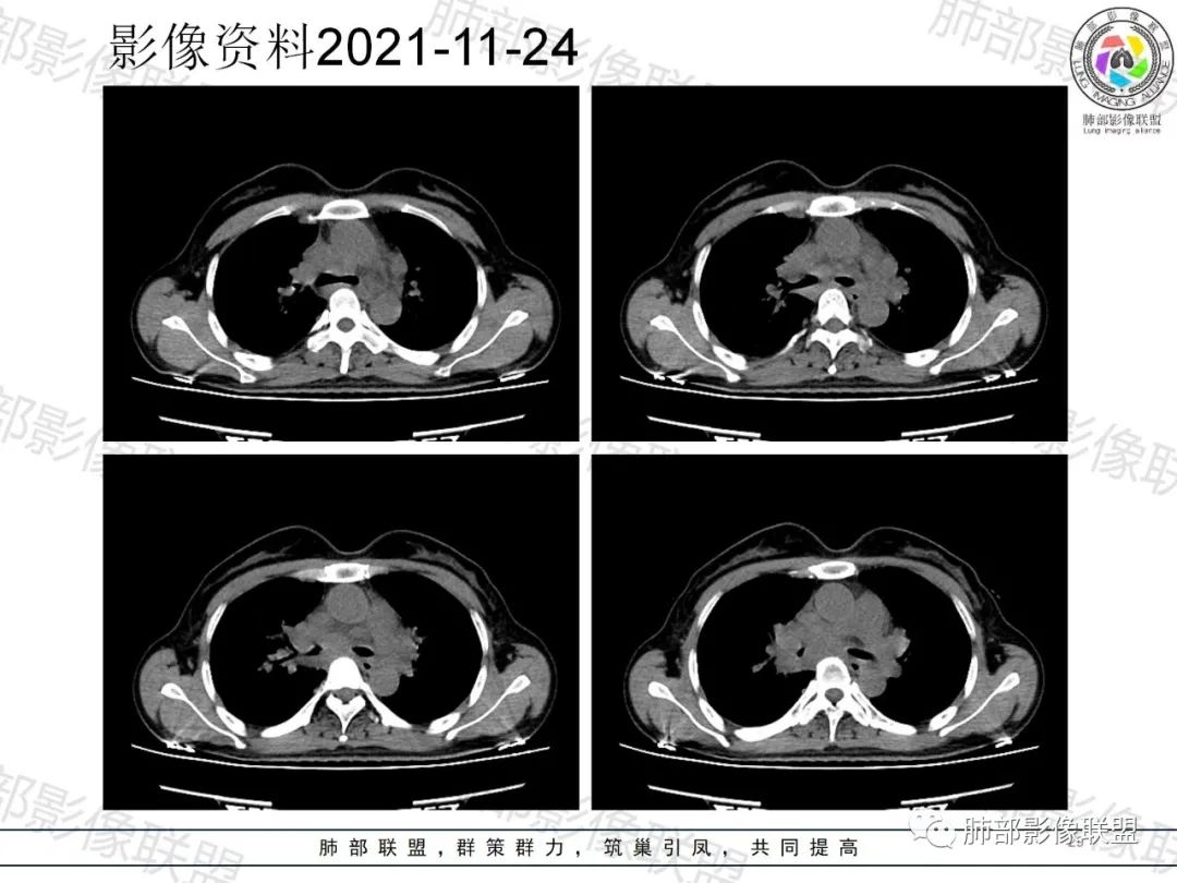 影像PPT - 【病例】诡异多变的结核-28 影像PPT - 【病例】诡异多变的结核-28
