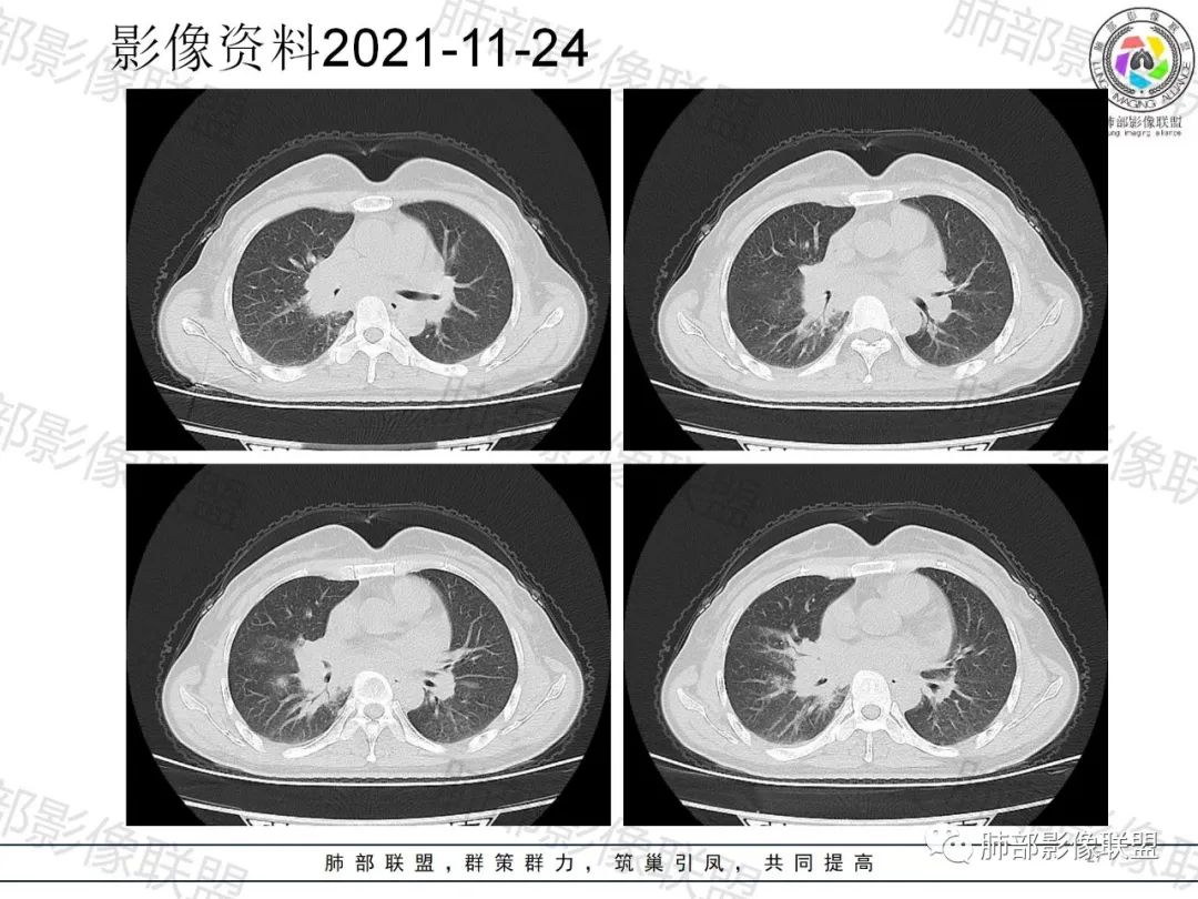 影像PPT - 【病例】诡异多变的结核-26 影像PPT - 【病例】诡异多变的结核-26