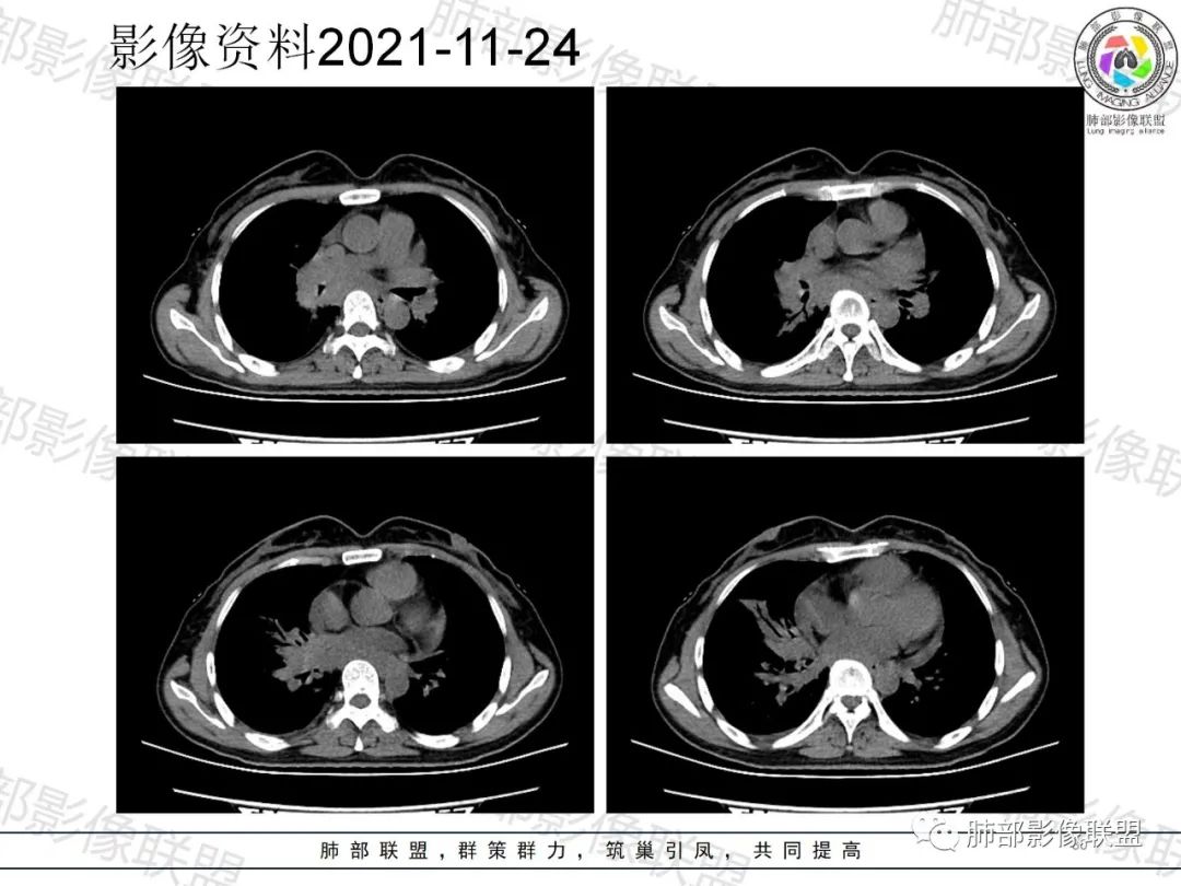 影像PPT - 【病例】诡异多变的结核-29 影像PPT - 【病例】诡异多变的结核-29