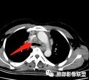 影像PPT - 【病例】诡异多变的结核-32 影像PPT - 【病例】诡异多变的结核-32