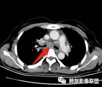 影像PPT - 【病例】诡异多变的结核-33 影像PPT - 【病例】诡异多变的结核-33