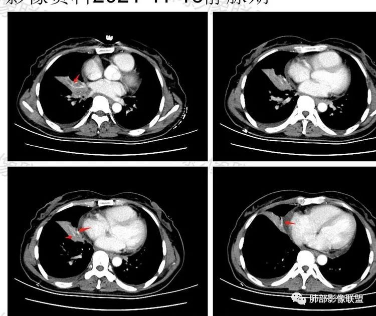 影像PPT - 【病例】诡异多变的结核-34 影像PPT - 【病例】诡异多变的结核-34