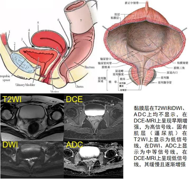 影像PPT - 【病例】6 个病例，6 种膀胱占位性病变，您愿意挑战一下么？-10