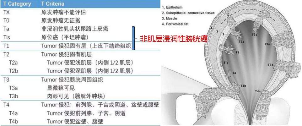 影像PPT - 【病例】6 个病例，6 种膀胱占位性病变，您愿意挑战一下么？-11