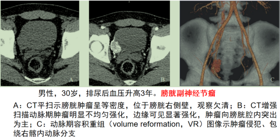 影像PPT - 【病例】6 个病例，6 种膀胱占位性病变，您愿意挑战一下么？-13
