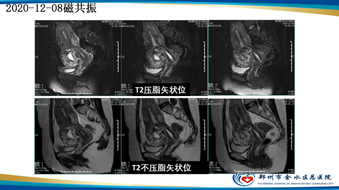 影像PPT - 【病例】瘢痕妊娠1例MR影像-6