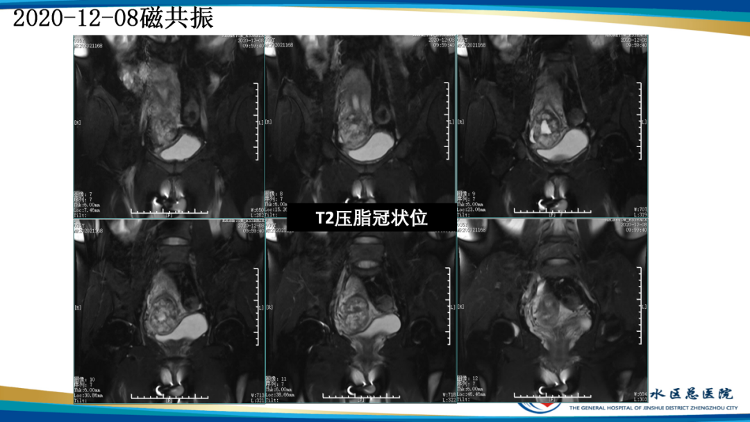 影像PPT - 【病例】瘢痕妊娠1例MR影像-8