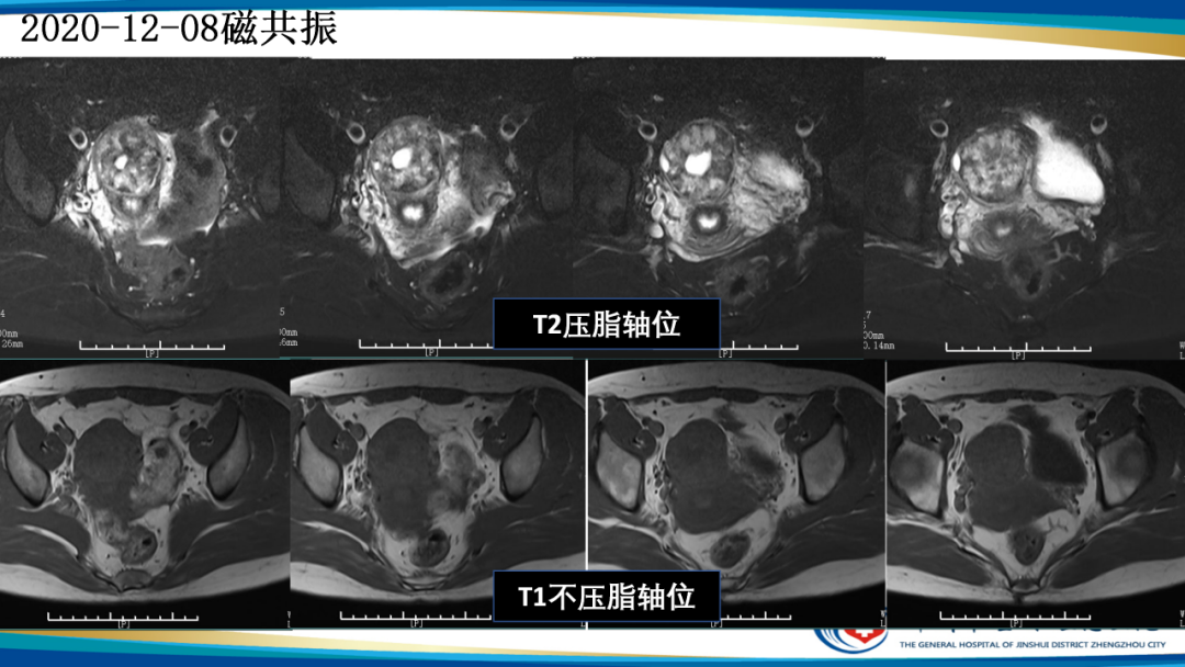 影像PPT - 【病例】瘢痕妊娠1例MR影像-7