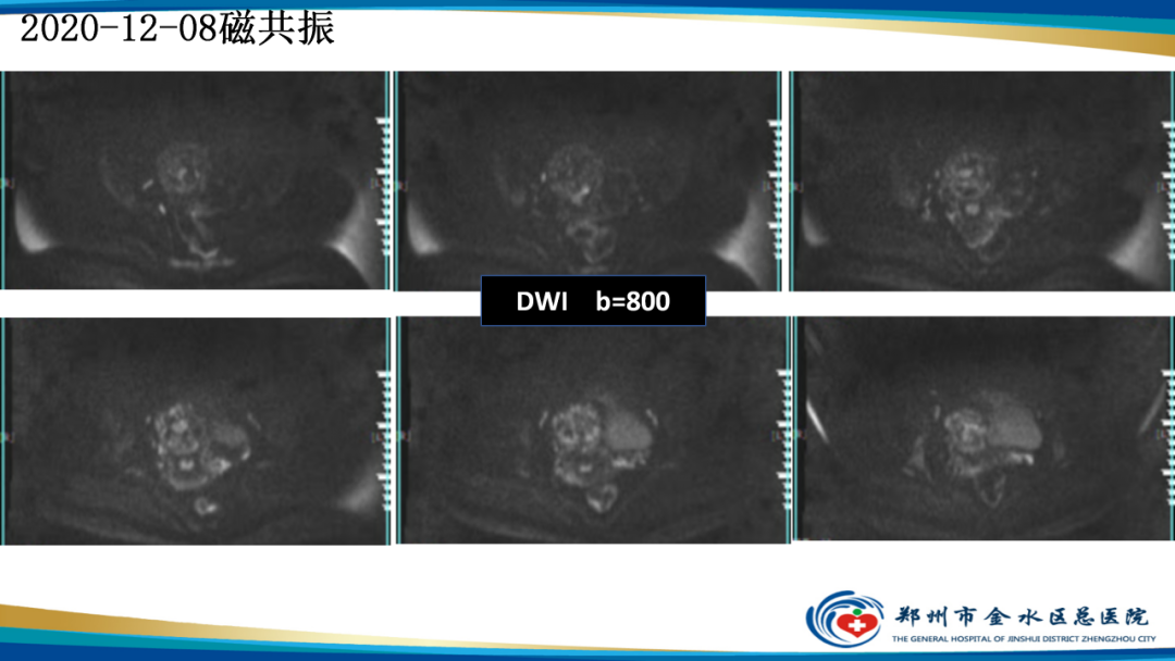 影像PPT - 【病例】瘢痕妊娠1例MR影像-9