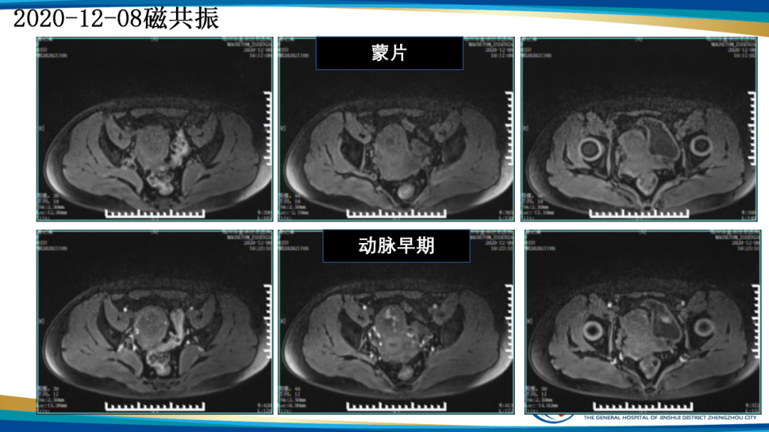影像PPT - 【病例】瘢痕妊娠1例MR影像-10