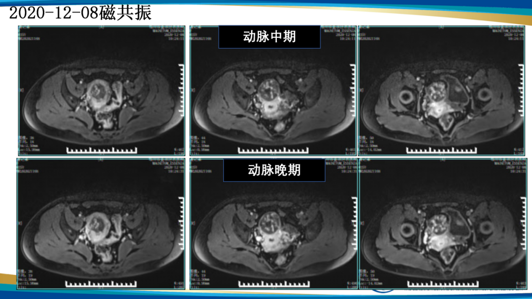 影像PPT - 【病例】瘢痕妊娠1例MR影像-11