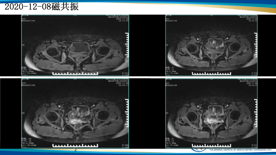 影像PPT - 【病例】瘢痕妊娠1例MR影像-14