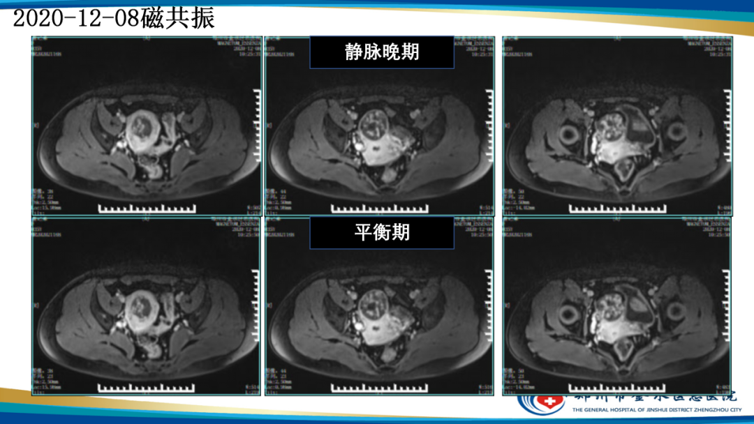 影像PPT - 【病例】瘢痕妊娠1例MR影像-13