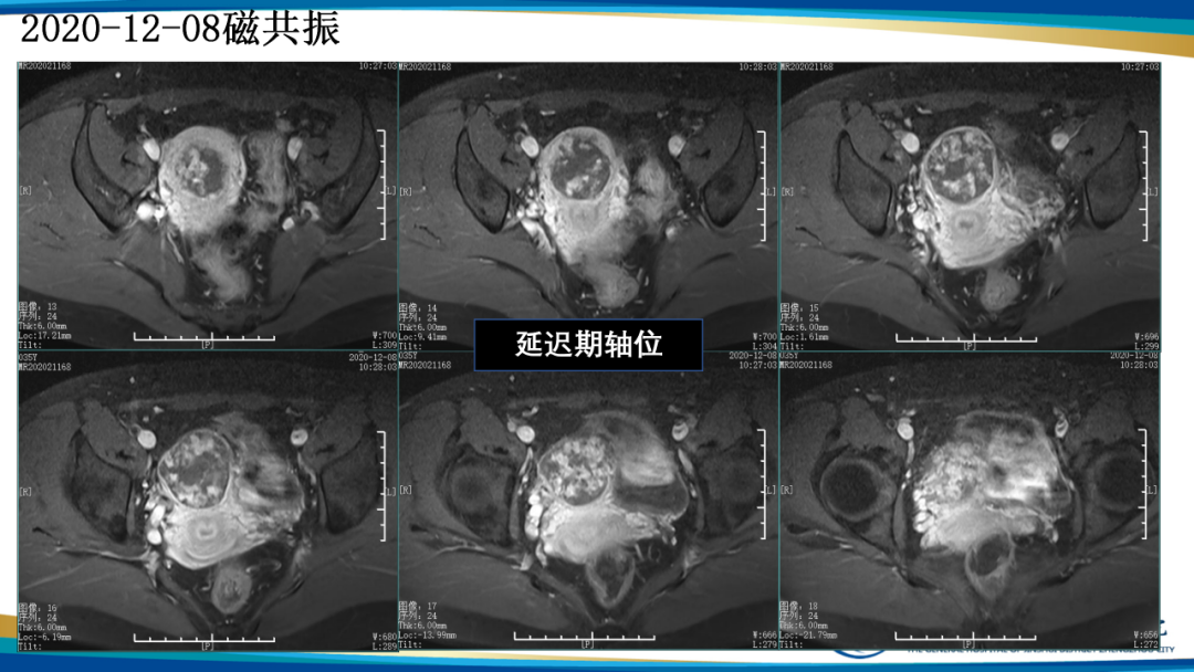 影像PPT - 【病例】瘢痕妊娠1例MR影像-16