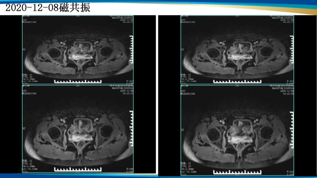 影像PPT - 【病例】瘢痕妊娠1例MR影像-15