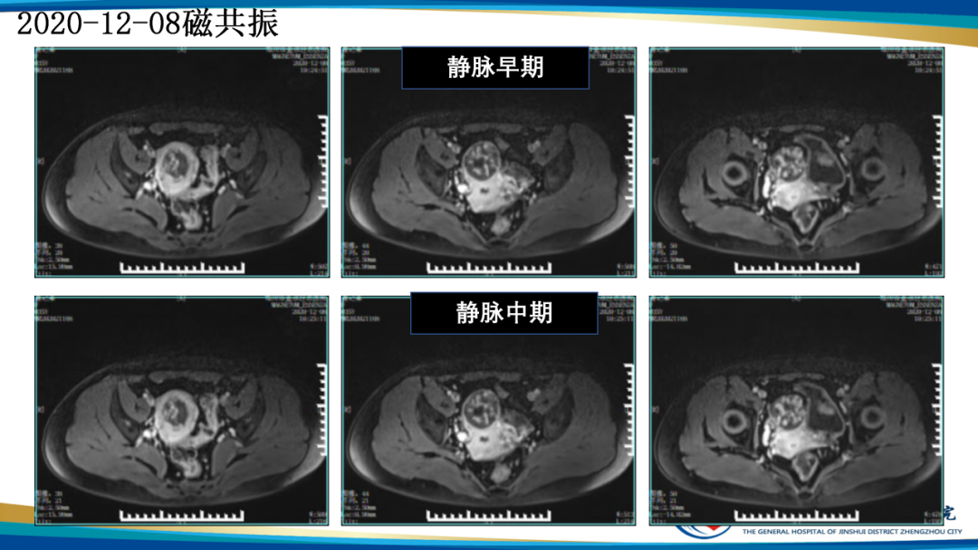 影像PPT - 【病例】瘢痕妊娠1例MR影像-12