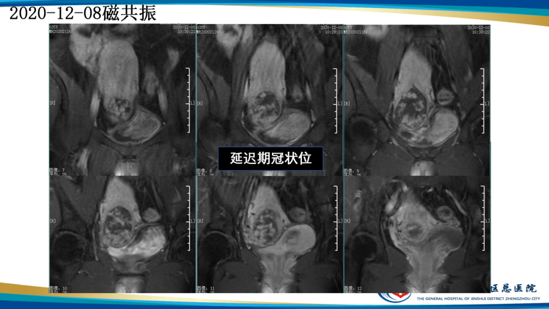 影像PPT - 【病例】瘢痕妊娠1例MR影像-17