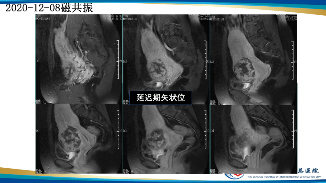 影像PPT - 【病例】瘢痕妊娠1例MR影像-18