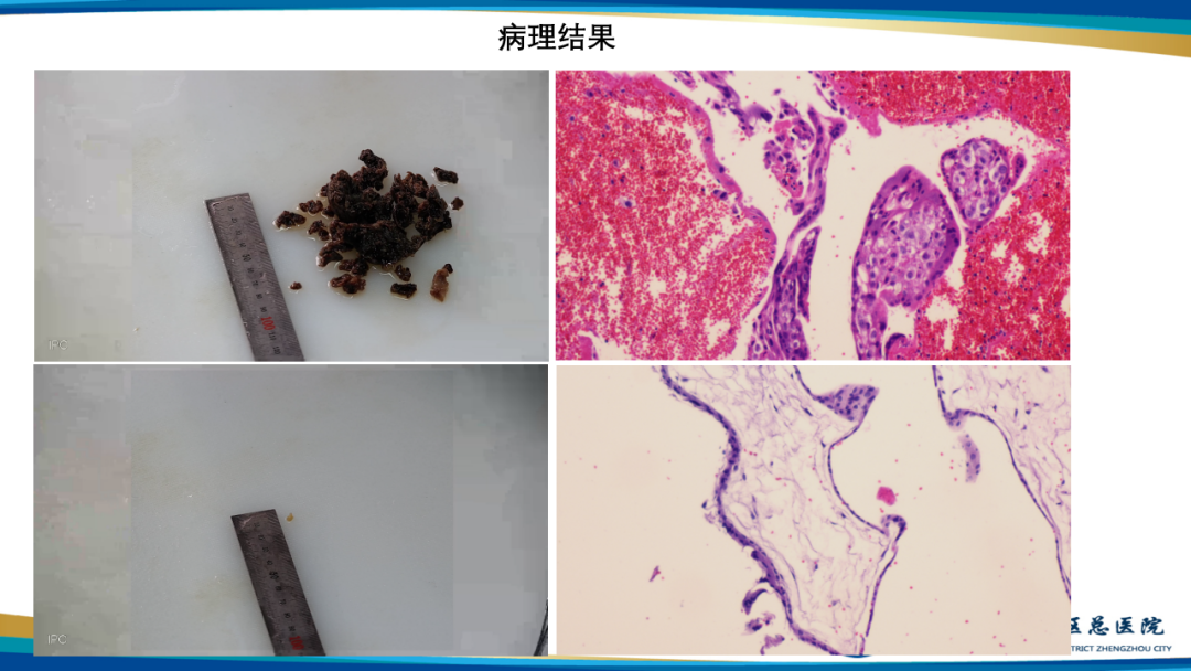 影像PPT - 【病例】瘢痕妊娠1例MR影像-23