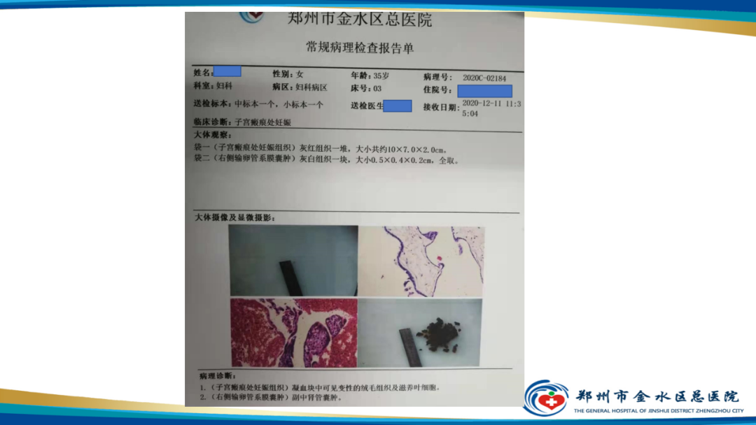 影像PPT - 【病例】瘢痕妊娠1例MR影像-25