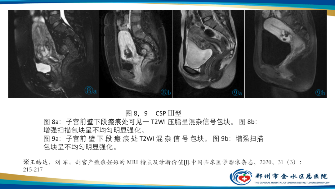 影像PPT - 【病例】瘢痕妊娠1例MR影像-33