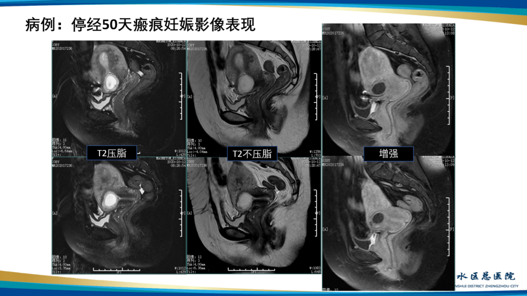 影像PPT - 【病例】瘢痕妊娠1例MR影像-31