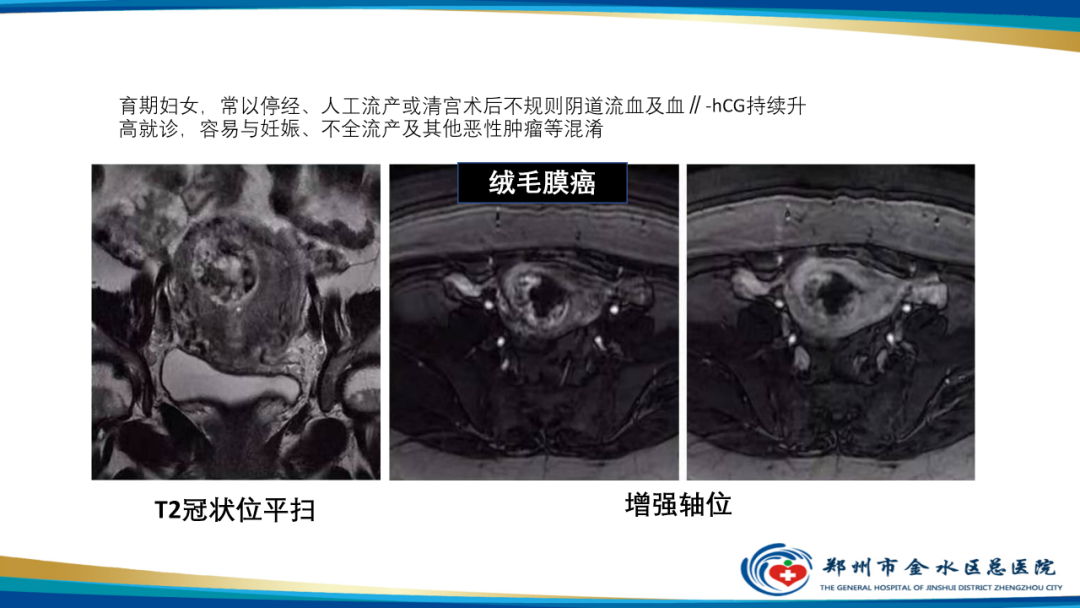 影像PPT - 【病例】瘢痕妊娠1例MR影像-37