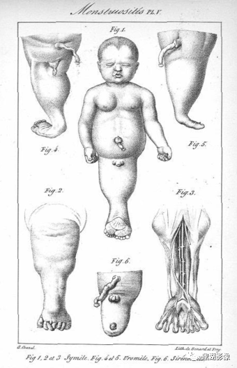 影像PPT - 美人鱼综合征(sirenomelia病)的片子您见过吗?-2 影像PPT - 美人鱼综合征(sirenomelia病)的片子您见过吗?-2