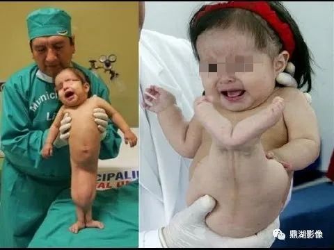影像PPT - 美人鱼综合征(sirenomelia病)的片子您见过吗?-5 影像PPT - 美人鱼综合征(sirenomelia病)的片子您见过吗?-5