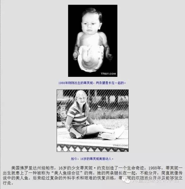 影像PPT - 美人鱼综合征(sirenomelia病)的片子您见过吗?-6 影像PPT - 美人鱼综合征(sirenomelia病)的片子您见过吗?-6