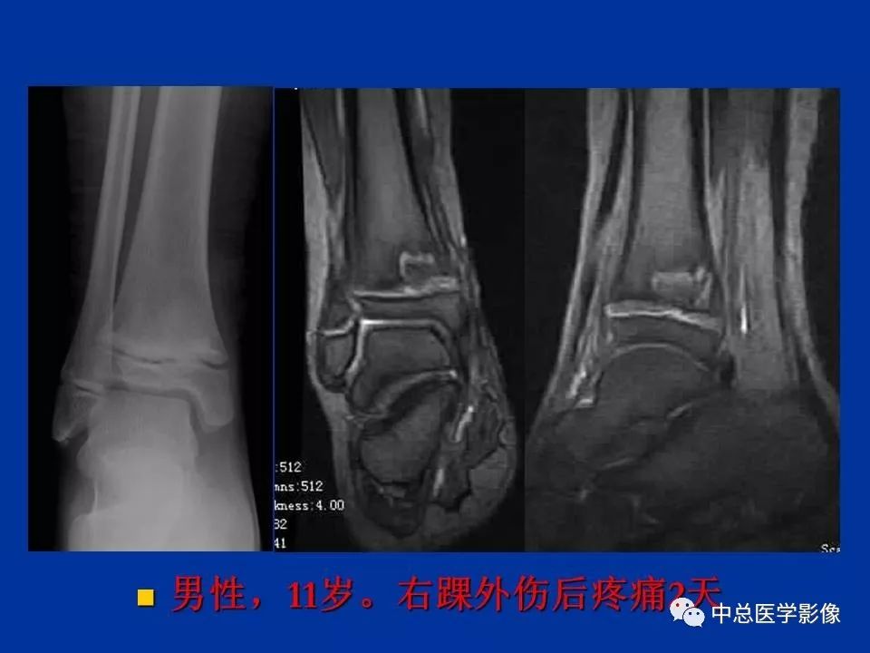 影像PPT - 【PPT】骨骺软骨损伤MR诊断-2