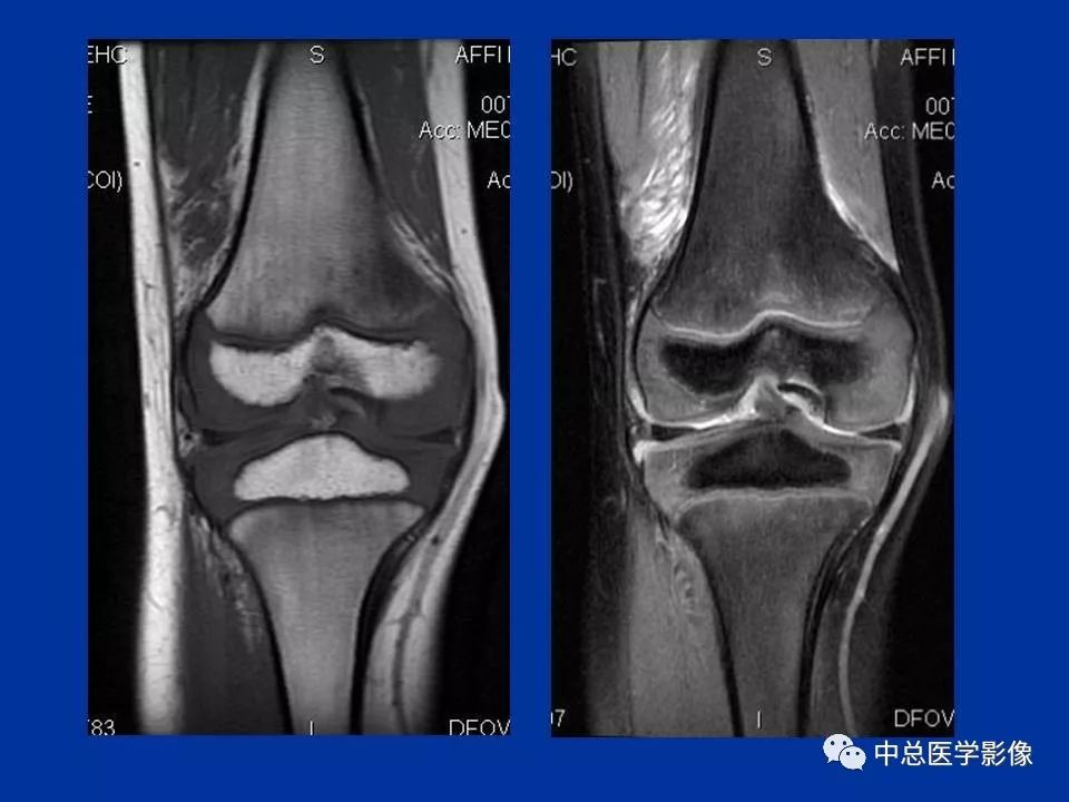 影像PPT - 【PPT】骨骺软骨损伤MR诊断-6
