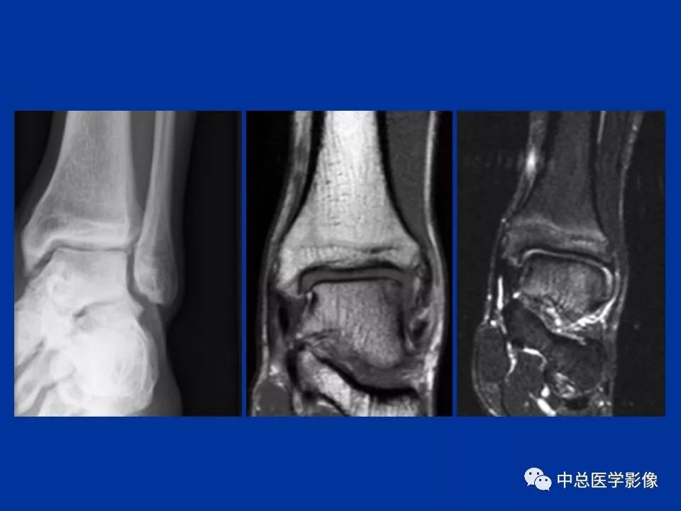 影像PPT - 【PPT】骨骺软骨损伤MR诊断-7