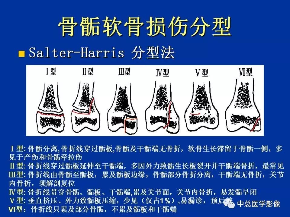 影像PPT - 【PPT】骨骺软骨损伤MR诊断-10
