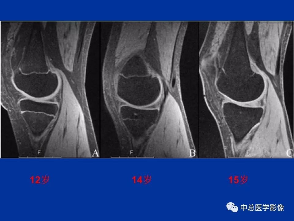 影像PPT - 【PPT】骨骺软骨损伤MR诊断-8