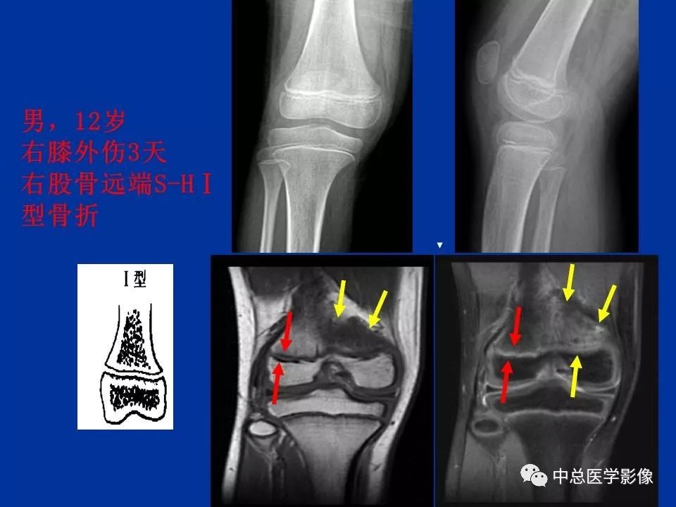影像PPT - 【PPT】骨骺软骨损伤MR诊断-16