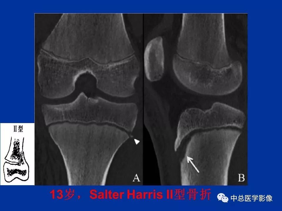 影像PPT - 【PPT】骨骺软骨损伤MR诊断-18
