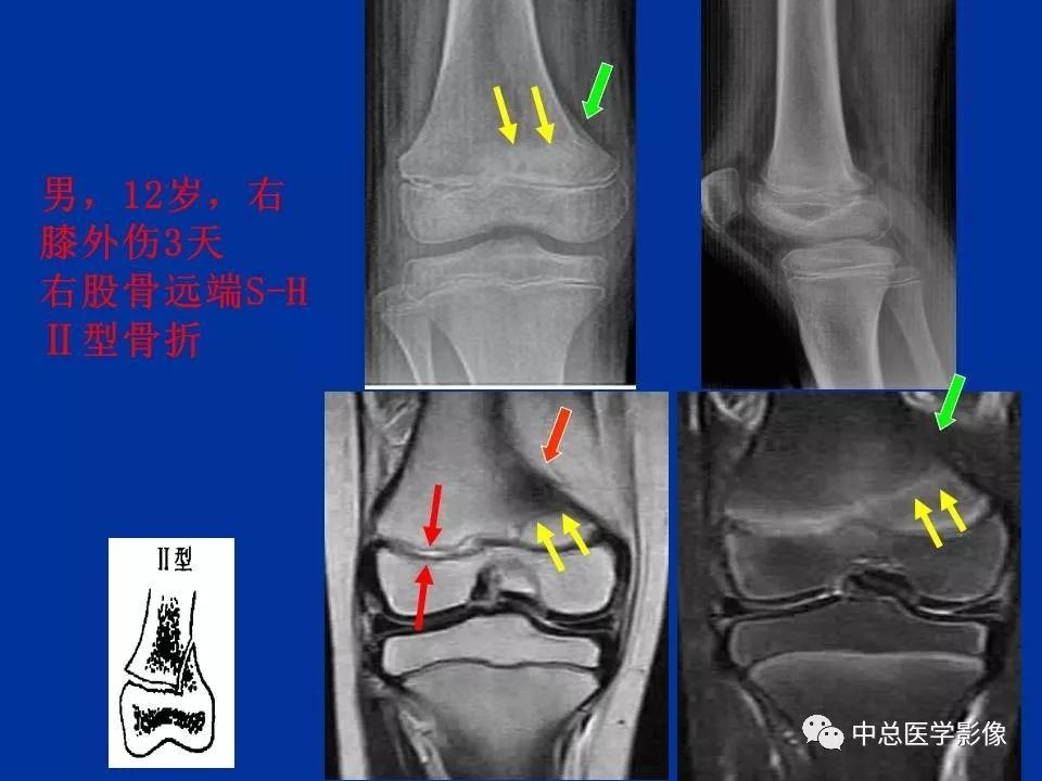 影像PPT - 【PPT】骨骺软骨损伤MR诊断-17