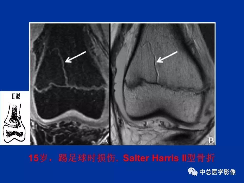 影像PPT - 【PPT】骨骺软骨损伤MR诊断-19